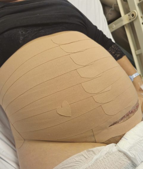 Aplicação de Taping no Pós Parto Aplicação de Taping no Pós Parto